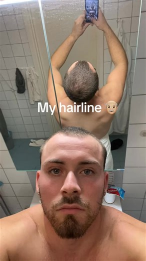 20K views · 222 reactions | 溺 Science ka formula jo baldness reverse...