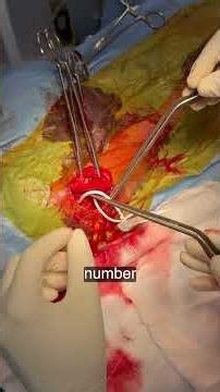 Codman Hakim | Programmable shunt | Dr Sumanth Mch | Helios Hospitals