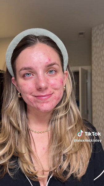 Debunking Acne Myths: Understanding Acne and Drug Allusions