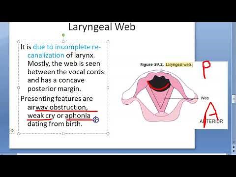 ENT 348 b Laryngeal Web Biphasic stridor