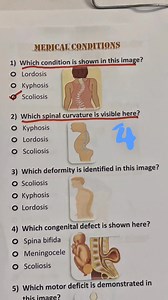 Test your knowledge of spinal cord and neurological conditions. Comment your answer! #neurology #spinal cord #medical #doctor #MedicalEducation #nurselife #quiz | Medi Quiz Pro