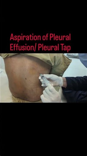 shorts, pleural tap, pleural effusion aspiration surgical,pulmonology,medical,health,Viralreelforyou