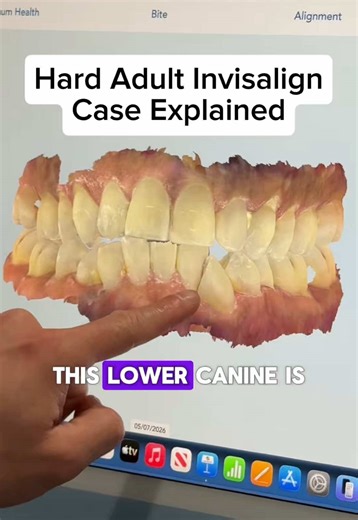 One of the biggest misconceptions about Invisalign is that straightening teeth is just about “making space” and lining things up. Real orthodontic treatment is a lot more complex than that. In this case, the patient is missing certain adult teeth, which completely changes how we have to think through the treatment plan. One lower canine is tipped over and blocking another tooth, while the lower front teeth are shifted off-center and leaning backward. At first glance, you might think, “Just make 