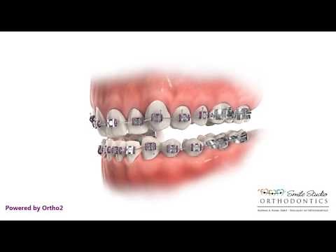 Bite Turbos - Orthodontic Treatment