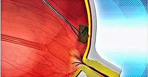 Bio-Retina to enter clinical trials in 2013
