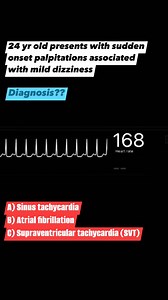 167K views · 835 reactions | 24-year-old patient presents with sudden onset palpitations associated with mild dizziness. He is alert, normotensive, no chest pain or syncope, and symptoms have been present for 1 hour. What’s the diagnosis? Comment down ⬇️ #ekg #ecg #cardiology #cardiologia #nursing #ECG #ecgchallenge #cardiology #fblifestyle | Medicine for all | Facebook