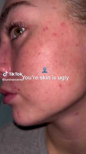 Transform Your Skin with Luminance Red!