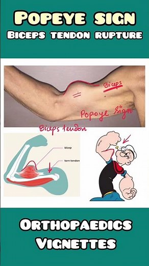 "Popeye Sign" in biceps tendon rupture explained for USMLE, NEET PG, NCLEX #neet #usmle #doctor