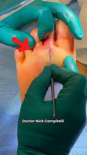 💥 Insane Foot Abscess Drainage! Watch This Pusplosion in Action #Shorts