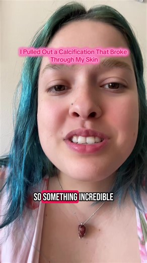 Miraculous Removal of Calcification from My Skin