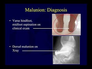 Talus fractures 3 - complications of talar neck fx (OTA lecture series III l14c)