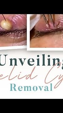 Unveiling Eyelid Cyst Removal