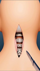 3M views · 10K reactions | How brain clot is removed? (3D Animation) @learning4growthh #shorts #learning #brain #clots #surgery #personal #docter #neet #neetscam #knowledge #gyan #trending #reels #brainsurgery #brainhealth #brainoperation #casestudy #animation #3danimation #human #brainpower #science #sciencefacts #factsoftheday #factsyoudidntknow #factsdaily | Learning4growthh | Facebook