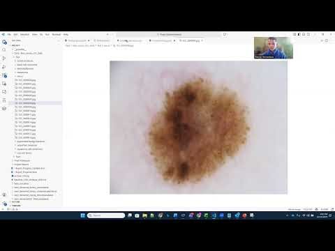Demo - Skin Cancer Classification Using Convolutional Neural Networks