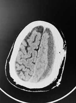 Middle meningeal artery embolisation for sub dural hematoma