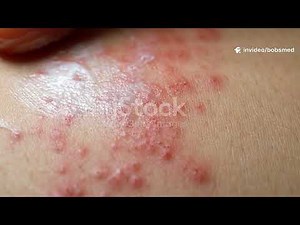 Scabies: Causes, Symptoms & Treatment | How to Get Rid of Scabies Fast
