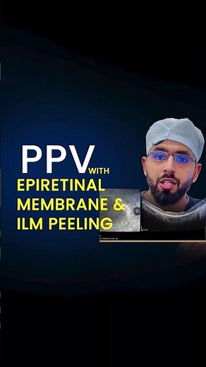 PPV with Epiretinal membrane and ILM peeling
