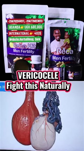 🔥 VARICOCELE! BECOME A FATHER TODAY 🔥 Varicocele is one of the leading causes of male infertility — swollen veins that make the testicles too warm for healthy sperm production. Some men feel pain… others feel nothing. But the damage happens quietly. If untreated, it can lead to: • Low sperm count • Poor motility • DNA-damaged sperm • Low testosterone • Shrinking of the testicles The Reca Fertility Kit supports recovery by: ✔ Improving blood flow around the testes ✔ Reducing internal inflammati