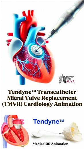Tendyne™ Transcatheter Mitral Valve Replacement (TMVR) | Cardiology Animation #3d #short