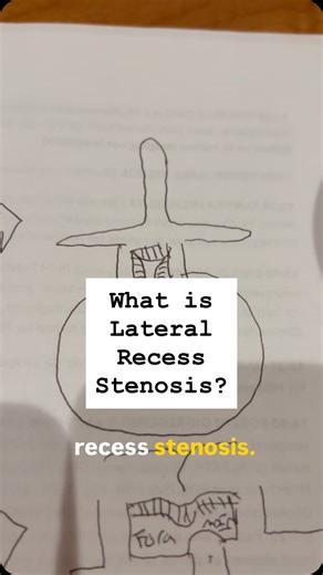 Albert Telfeian, MD | Best Spine Surgeon NYC on Instagram: "Lateral recess stenosis is one of the most common — and overlooked — causes of leg pain and sciatica. 🧠💥 With endoscopic spine surgery, we can precisely decompress the nerve through a tiny incision, often without fusion, and get patients back to life faster. 💪✨ ⸻ Hashtags: #EndoscopicSpineSurgery #LateralRecessStenosis #SpinalStenosis #SciaticaRelief #BackPainTreatment #MinimallyInvasiveSpine #EndoscopicDecompression #SpineSurgeon #O