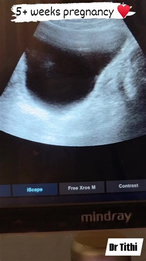 Understanding 5 Weeks Pregnancy with Dr. Tainin Tithi