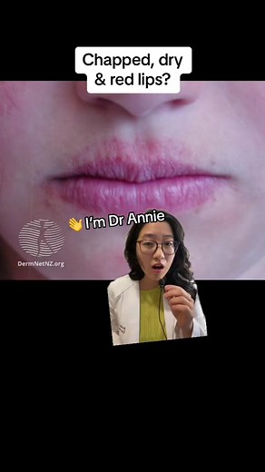 Chapped Lips? Causes & Solutions by Dr Annie