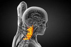 Cervical stenosis: symptoms, causes, diagnosis and treatment