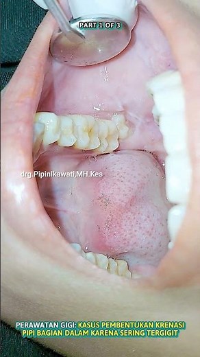 A CASE OF CRENATION FORMATION ON THE INNER CHEEKS DUE TO FREQUENT BITING || PART 1 OF 3