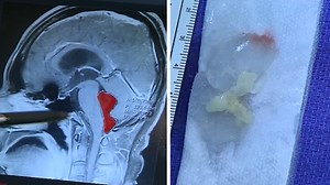 Austin man has tapeworm removed after over a decade in his brain