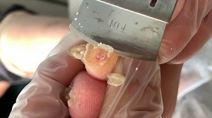 42K views · 320 reactions | Calluses on the toes, chronic friction【Xiao Yan Pedicure】 | Xiao Yan Pedicure | Facebook