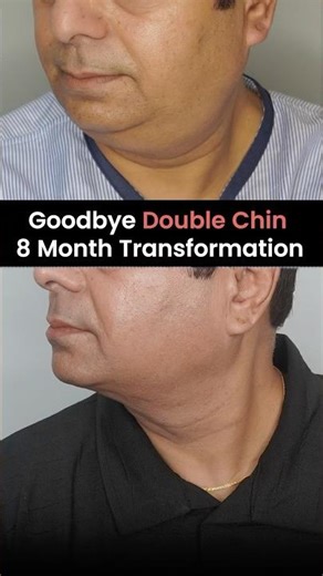 Goodbye Double Chin 15 Days Transformation | Double Chin Liposuction Surgery in India