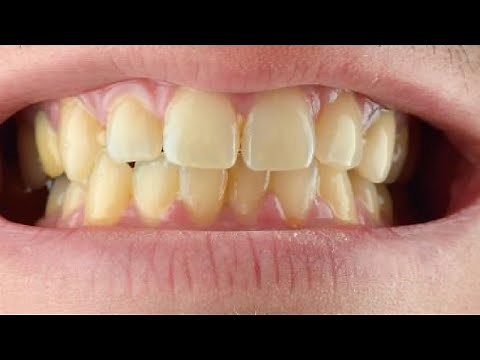 how to get rid of yellow teeth stains fast and easy