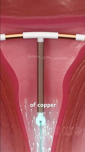 Ever Wondered How an IUD Works Inside the Uterus? (3D Animation) #iud #iudinsertion #birthcontrol