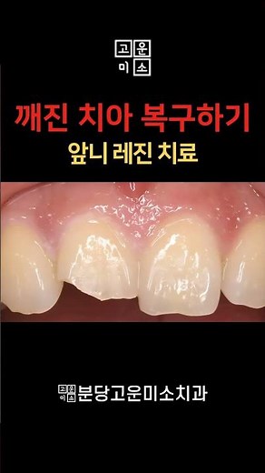 깨진 치아 복구하기 앞니 레진 치료