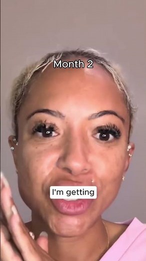 Acne Scar Progression Over 4 Months. Using the finest needles for almost no pain #acnescars #acne