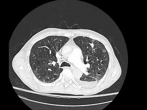 Pulmonary infarction on CT