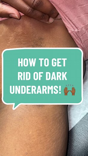 Underarm wax with Matcha 🍵 by Wakse. So many things can be the reason why you have dark underarms but I know for sure a few that has caused it. Even down to the deodorant you use can be a reason! #viralreelsfacebook #reelsviralシ #exfoliate #discoloration #foryoupage #matcha #wax #hairremoval #esthetician #estheticianlife #satisfying | Waxing Queen
