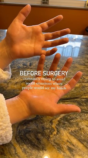 The Center for Hyperhidrosis on Instagram: "Hi everyone, Bri here! If you aren’t familiar with my story here’s a little run down: I was born with a condition we know as Hyperhidrosis affecting my hands, feet, & underarms. I tried so many “treatments” to help with the sweat & nothing worked… I thought this was just my life & I have to learn to deal with it. One day I hit my breaking point with this condition, I was over the sweating & started researching. That is when I found The Center for Hyper