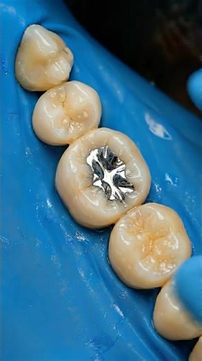 Preenchimento de Dente com Amálgama #asmr #satisfatório