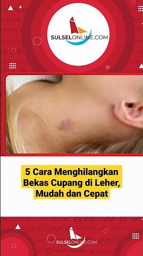 Cara Ampuh Menghilangkan Bekas Cupang di Leher, Mudah dan Cepat #shorts