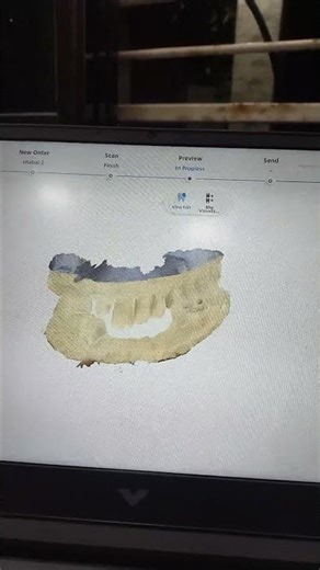 shining 3D model scan🦷🦷🤯#shining3Dscanner#shorts #dentaldoctor #dentallab #cadcam #exocad #youtube