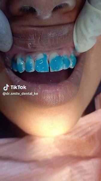 Braces start @ #Dr smile dental ke#kikuyuisbae #kambatiktokers #foryoupage❤️❤️ #somalitiktok #boranatiktok #fypp #Dr