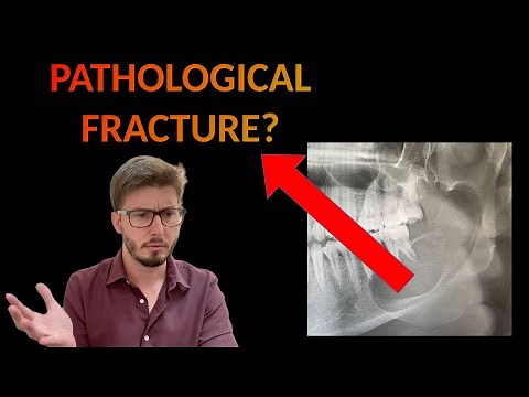 Marsupialization Fully EXPLAINED: Oral Surgery Tutorial (Cases of Odontogenic Cysts, OKC and Tumors)