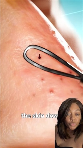 How Blackhead Extraction Works #duet #review
