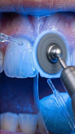 Fixing a Front Tooth Notched from Opening Bottles Instantly