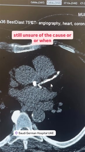 Shady Habboush on Instagram: "This is a CT scan of the heart — specifically a coronary calcium scan. Coronary arteries should normally look soft and clean. When we see white areas, that is calcium — and calcium does not belong inside coronary arteries. This test is useful in two situations: • When someone has chest pain, but we’re still unsure of the cause • Or when a patient has risk factors like high cholesterol, and we’re undecided about starting lifelong medication This particular patient ha