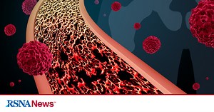 Cryoablation Effective in Relieving  Pain in Bone Metastasis