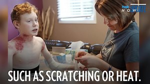 17-Year-Old 'Butterfly Child' with Rare Skin Disease Dies: He Was a 'Fearless Warrior,' Mom Says