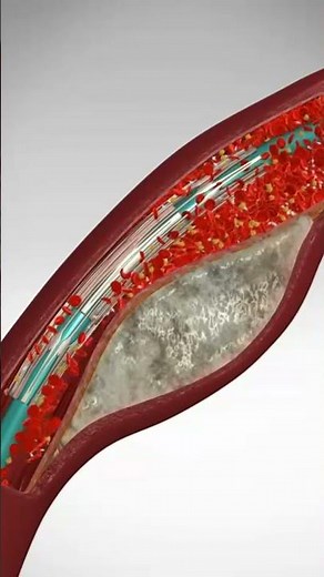 Saving Hearts: One Stent at a Time. See Angioplasty & Stent Placement #stents