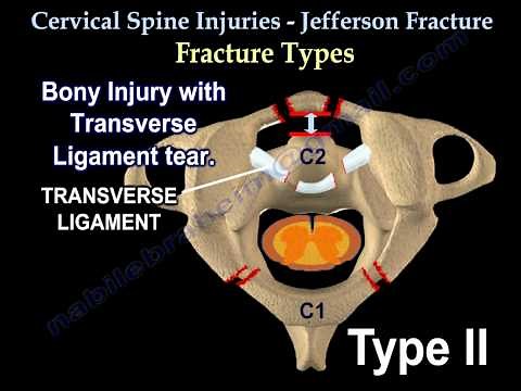 Cervical Spine Injuries Jefferson Fracture - Everything You Need To Know - Dr. Nabil Ebraheim